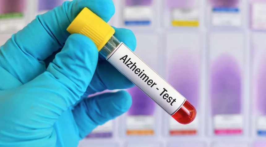 Game-Changer: Alzheimer's Blood Test Offers Hope For Early Detection ...