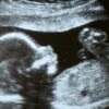 Fifty Years of Protecting Taxpayers From Funding Abortions Under Attack Again